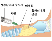 갑상선 세침 흡인검사