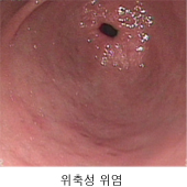 위축성 위염