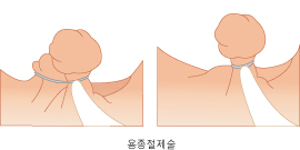 용종절제술