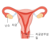 자궁경부암이란