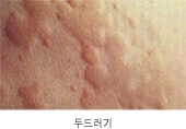 두드러기