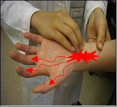 손목의 안쪽 표면에서 건막 위를 가볍게 두드릴 때 신경이 저리는 증상 (틴넬 검사 : Tinels sign)