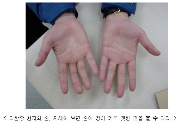 다한증 환자의 손, 자세히 보면 손에 땀이 가득 맺힌 것을 볼 수 있다.