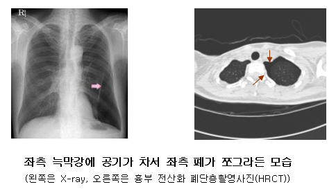 좌측 늑막강에 공기가 차서 좌측 폐가 쪼그라든 모습