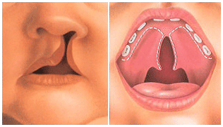 구순열과구개열