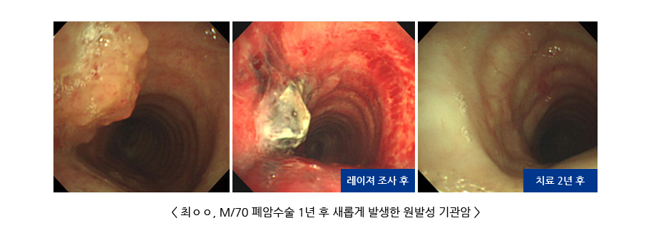 폐암수술 1년 후 새롭게 발생한 원발성 기관암