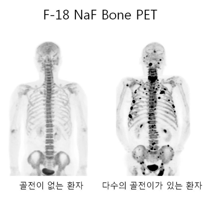 F-18 NaF bone PET