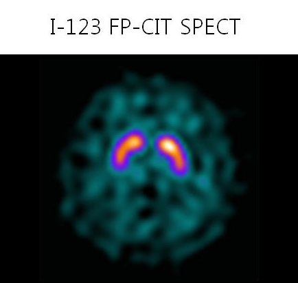 I-123 FP-CIT SPECT