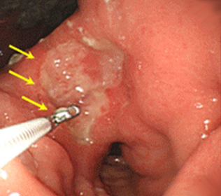 진행성 위암의 내시경 소견과 초음파 내시경 소견1
