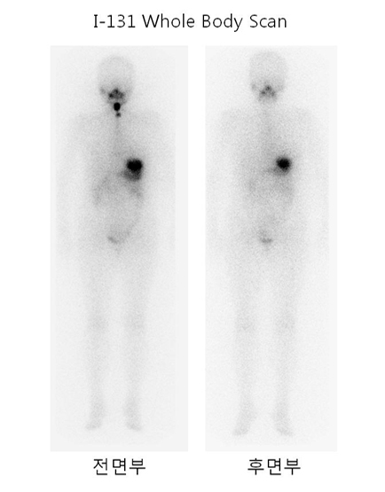 갑상선암 환자의 I-131 치료
