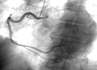 심혈관조영술2