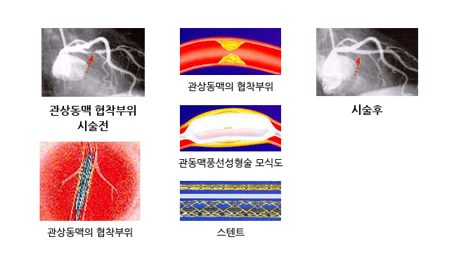 관상동맥중재술