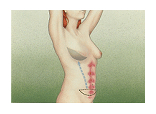 복부 근육 이식술