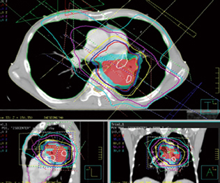 폐암(Jung cancer)의 전산화치료계획