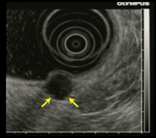 점막하 종양의 내시경 소견과 초음파 내시경 소견2