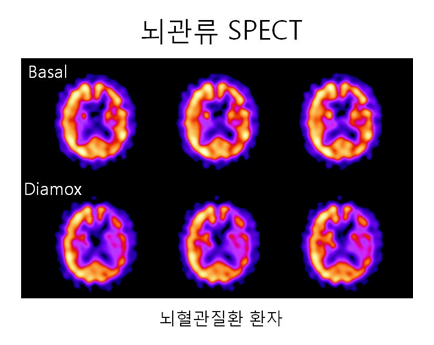 뇌혈관질환 등을 평가하기 위한 뇌관류 SPECT 검사