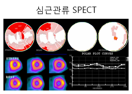 심혈관질환 평가를 위한 심근관류 SPECT 검사