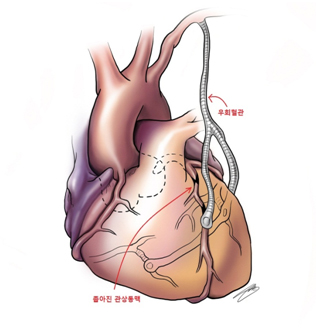 관상동맥우회술의 모식도