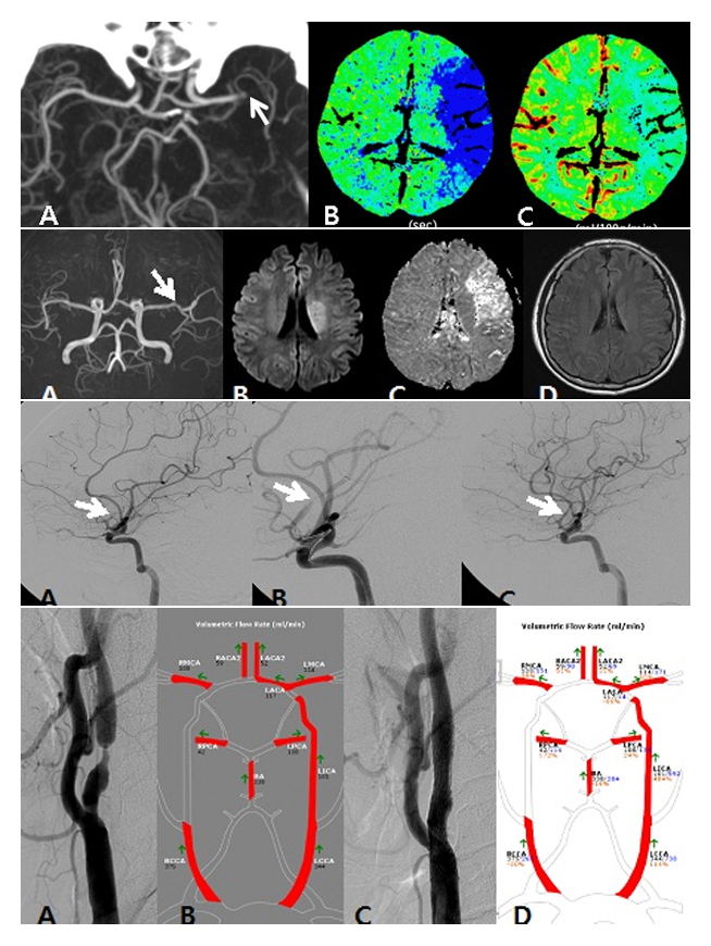 MR 혈관 조영술(MR angiography)은 조영제를 사용하지 않고도 혈관 영상을 얻을 수 있어 뇌혈관 질환 환자들의 혈관 상태 평가에 광범위하게 이용되고 있습니다. 