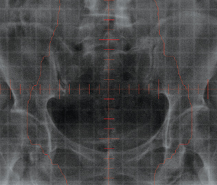 치료부위
			확인촬영(Linac Gram)의 예시