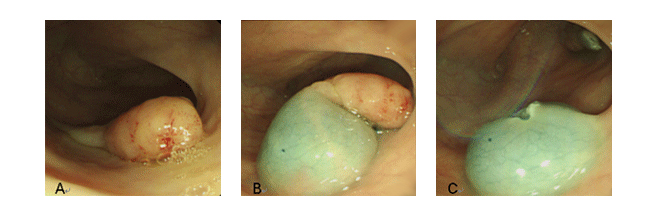A. 2cm 크기의 용종  B. 용종 절제를 위해 점막하 조직에 생리식염수를 주입한
					모습  C. 용종 절제 후 모습