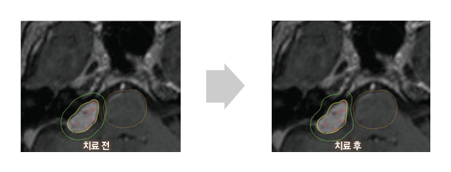 정밀한 치료.Dynamic shaping 기능을 이용하여 방사선(녹색)이 뇌간(brain stem)을 피하도록 치료계획을 수립한 예