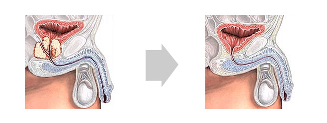 근치적 전립선적출술은 방광과 요도 사이에 위치한 전립선 및 정낭을 제거하고 방광과 요도를 문합하는 수술입니다.
