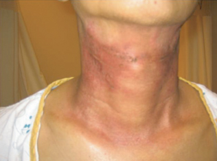 방사선 치료에
			의한 목 부위의 피부손상