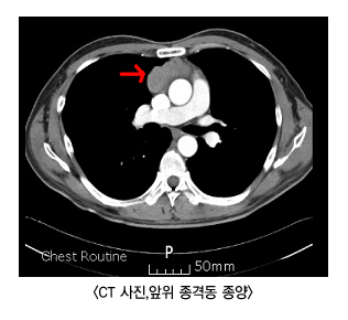 CT사진 앞위 종격동 종양