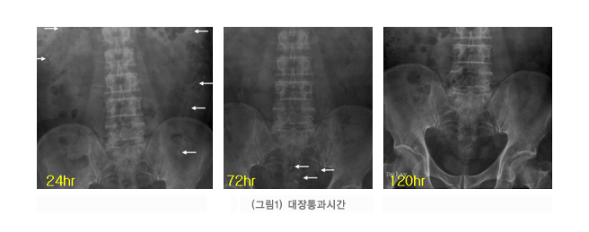 대장통과시간