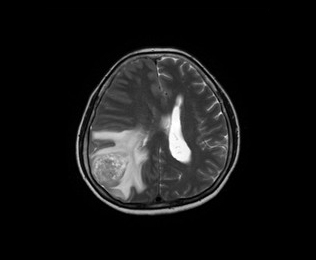 수술 후 병리검사 결과 교모세포종으로 진단되었던 환자의 수술 전 MRI1