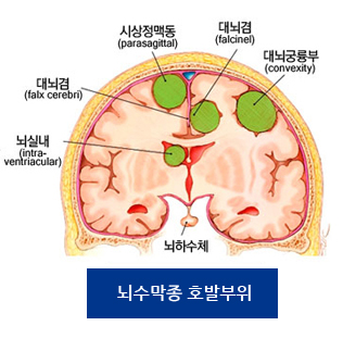 외수막종 호발부위