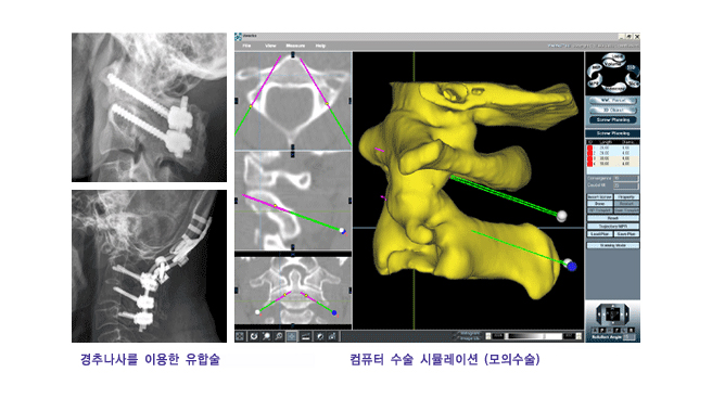 경추나사를 이용한 유합술, 컴퓨터 수술 시물레이션(모의수술)