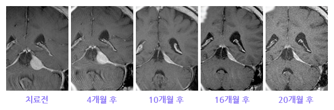 좌측 천막하부에 발생한 뇌수막종 치료사례 이미지