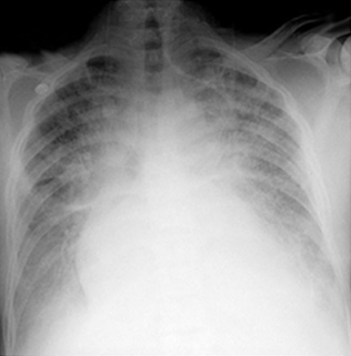 울혈성 심부전/폐부종 환자 가슴 사진