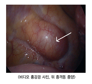 비디오 흉강경 사진,뒤 종격동 종양