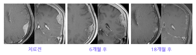 대뇌궁륭부에 발생한 뇌수막종 치료사례 이미지