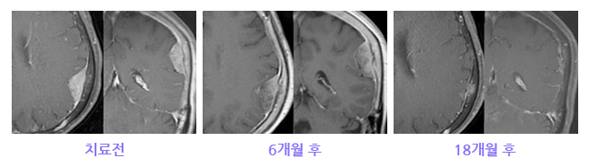 대뇌궁륭부에 발생한 뇌수막종 치료사례 이미지