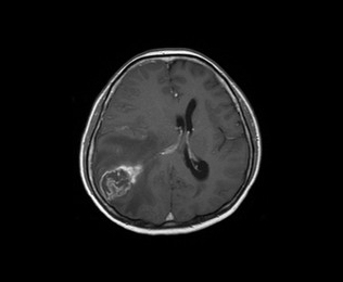 수술 후 병리검사 결과 교모세포종으로 진단되었던 환자의 수술 전, 후 MRI 사진1