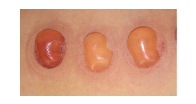 05_122.jpg 허벅지에 만든 수포