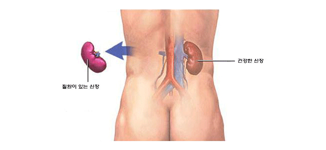 근치적 신적출술 : 질환이 있는 신장을 모두 제거합니다.> 