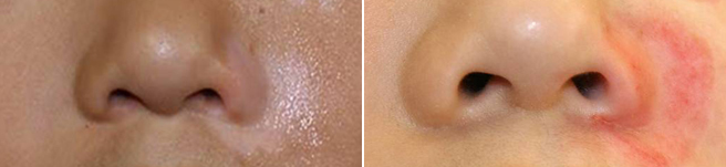 표피이식술 전,백반증 병변부 표피 제거 후