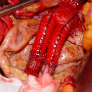 스텐트 그라프트 삽입후 발생된 합병증 치료사진