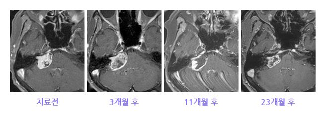 청신경초종 감마나이프수술 이미지