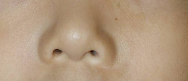 표피이식술 3개월 후