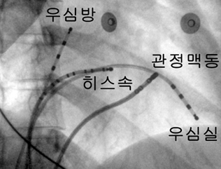 전극도자절제술 방법