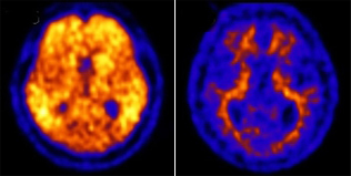 좌)알츠하이머병
		환자 amyloid-PET영상,우)정상인 amyloid-PET영상