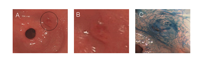 A.전정부(십이지장 넘어가기 직전) 후벽부에 발생한 미란 모양이 보인다.
B, A를 확대한 사진으로 미란 모양이 비교적 잘 보인다.
C, Indigocarmine 색소를 뿌려 그 부분이 좀더 잘 보인다.