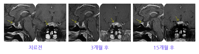 뇌하수체 치료 이미지