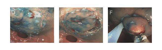 D. 내시경적 절개도(needle knife)로 제거할 부분을 표시했다.
E. 절개도의 끝에 절연체를 부착시킨 기구(IT knife)로 절개한 사진이다.
F. 절개한 부분에 올가미를 걸고 있는 모습이다.